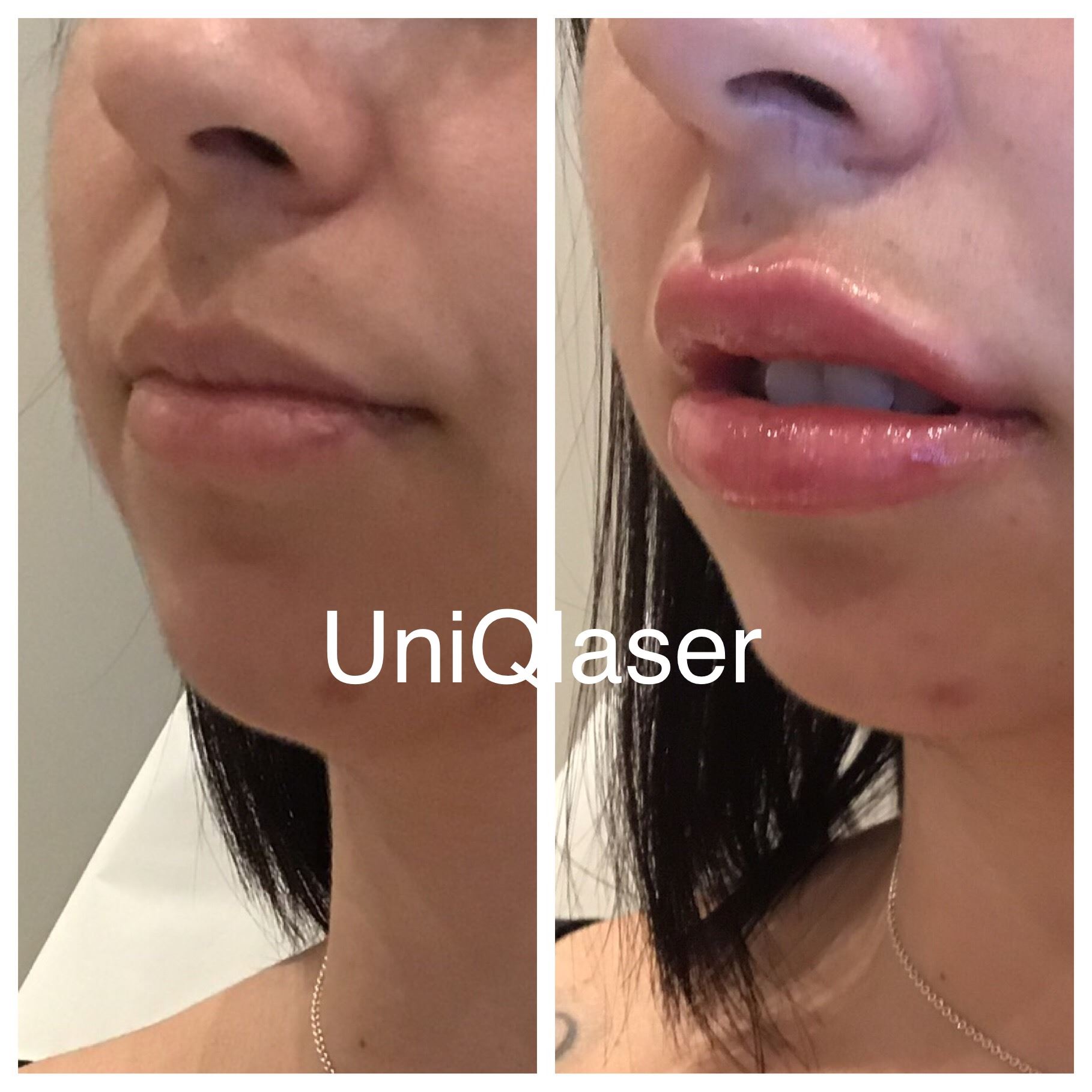 1-Juvederm-Voluma-before-and-after-photos-by-UniQ-Laser-Center-in-Canton-MA