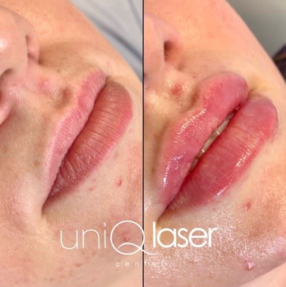 1-Restalyne-Kysse-Removal-before-and-after-photos-by-UniQ-Laser-Center-in-Canton-MA