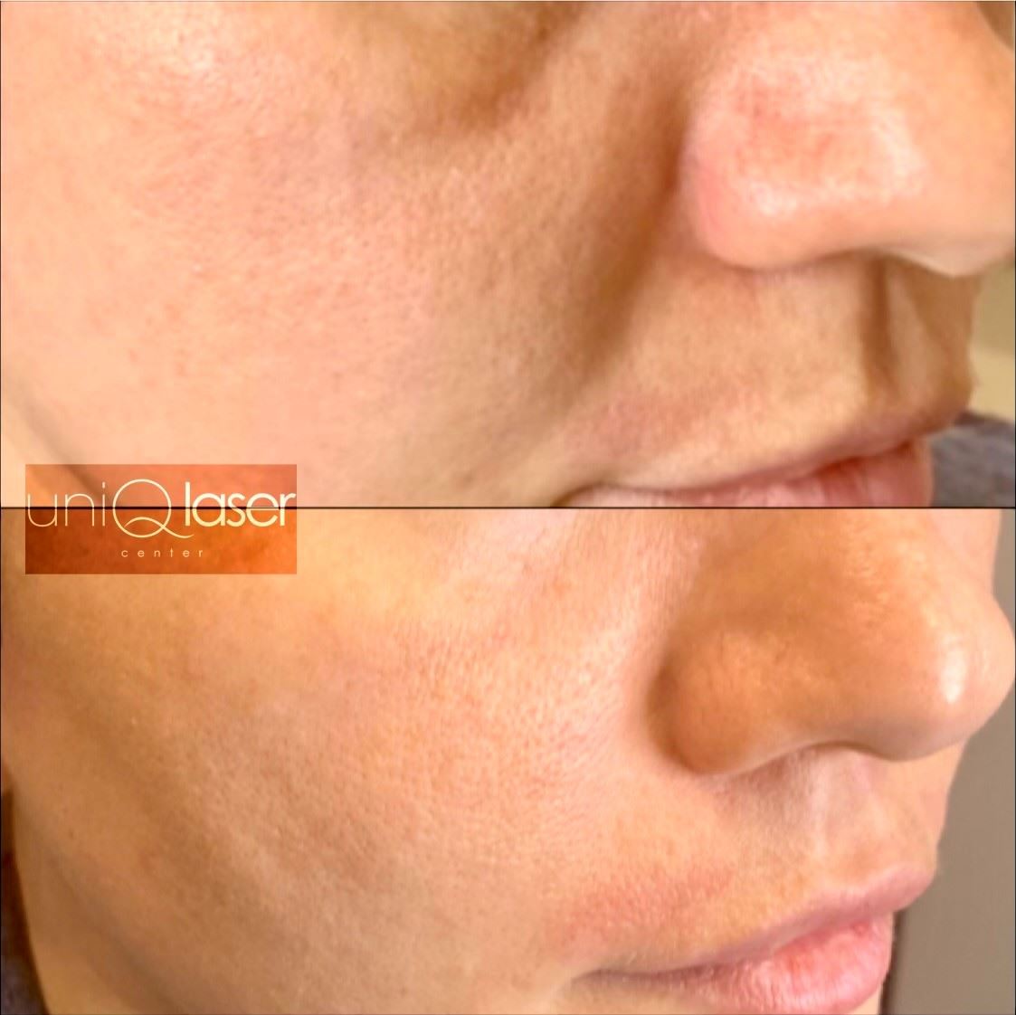 10-Restalyne-Kysse-Removal-before-and-after-photos-by-UniQ-Laser-Center-in-Canton-MA