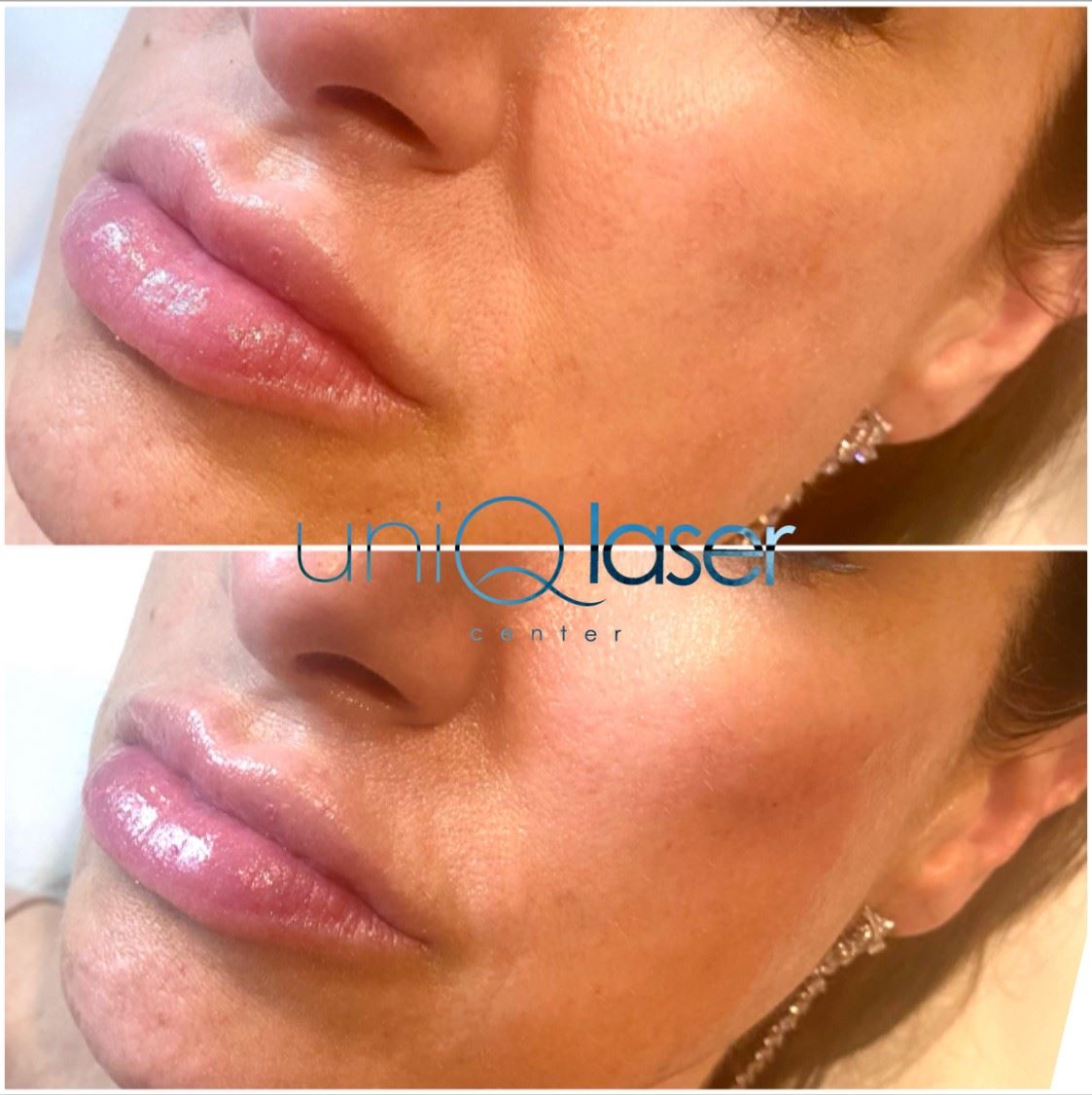 3-Restalyne-Kysse-Removal-before-and-after-photos-by-UniQ-Laser-Center-in-Canton-MA