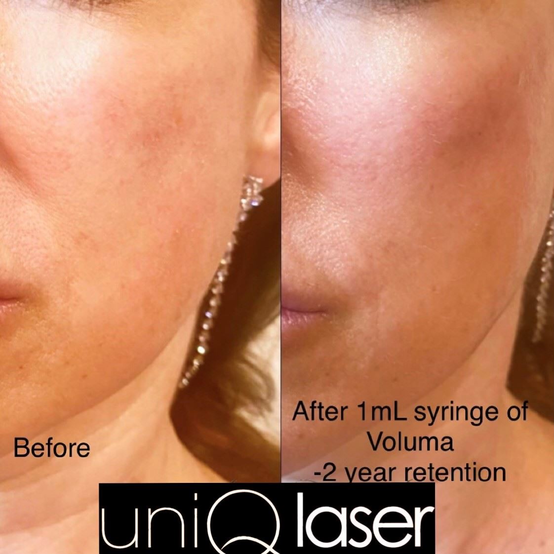 4-Restalyne-Kysse-Removal-before-and-after-photos-by-UniQ-Laser-Center-in-Canton-MA