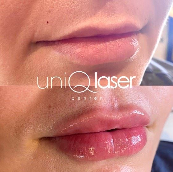 5-Restalyne-Kysse-Removal-before-and-after-photos-by-UniQ-Laser-Center-in-Canton-MA