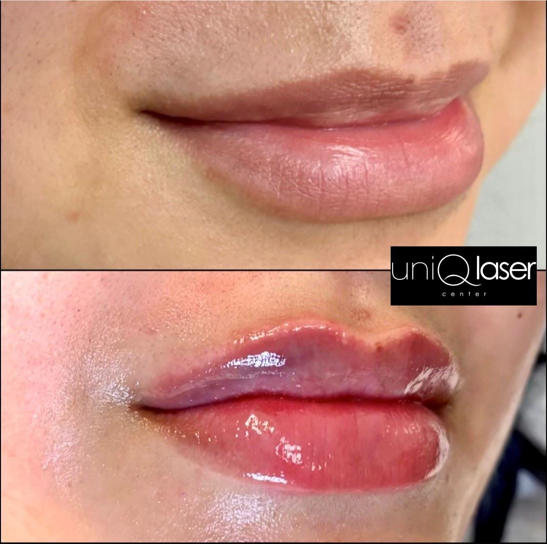 9-Restalyne-Kysse-Removal-before-and-after-photos-by-UniQ-Laser-Center-in-Canton-MA