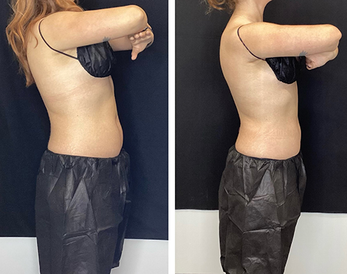 Coolsculpting-Before-and-After-Photos-by-UniQ-Laser-Center-in-Canton-Watertown-Saugus-MA-1