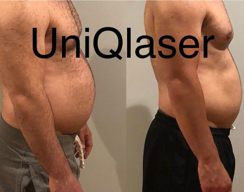 Coolsculpting-Before-and-After-Photos-by-UniQ-Laser-Center-in-Canton-Watertown-Saugus-MA-2