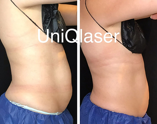 Coolsculpting-Before-and-After-Photos-by-UniQ-Laser-Center-in-Canton-Watertown-Saugus-MA-3
