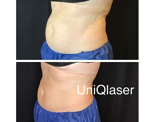 Coolsculpting-Before-and-After-Photos-by-UniQ-Laser-Center-in-Canton-Watertown-Saugus-MA-5